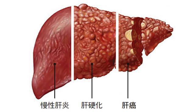 丙肝病毒量越高，是不是病情越嚴(yán)重？怎么樣判斷病情？ 